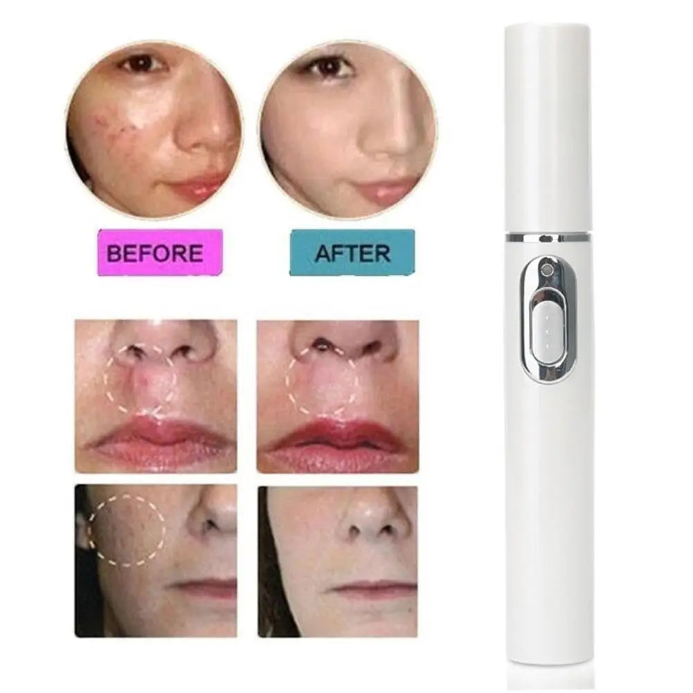 Blue Light Therapy Acne Laser Pen